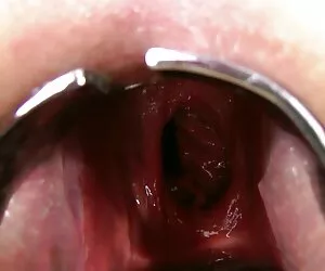 فاصله دوبار کاوشگر مقعدی